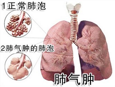 小儿肺气肿的早期症状是什么?